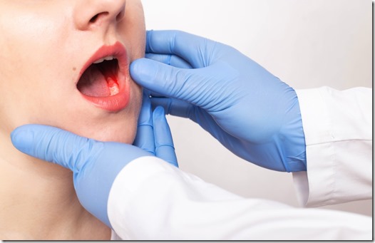 Foto cáncer mandibular