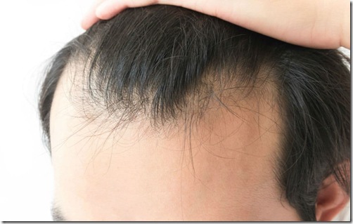 Alopecia-androgenica_08765